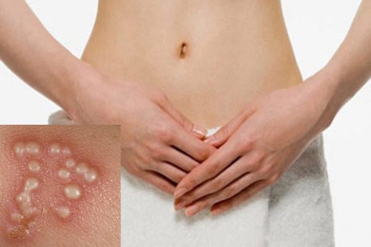 3 bệnh lây truyền dễ nhiễm qua quan hệ tình dục bằng miệng- Ảnh 2.