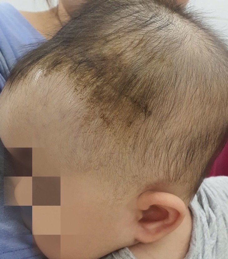 Bé 7 tháng tuổi tụ máu dưới da đầu từ cú ngã tưởng như vô hại- Ảnh 1.