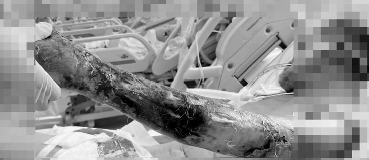 14 ngày căng thẳng giành giật sự sống cho bệnh nhân nhiễm vi khuẩn tụ cầu vàng- Ảnh 1.
