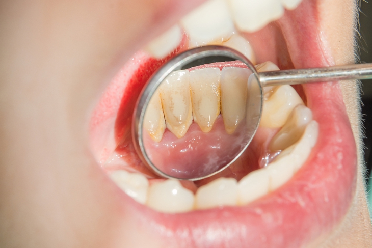 Chế độ ăn giúp loại bỏ cao răng tại nhà- Ảnh 2.