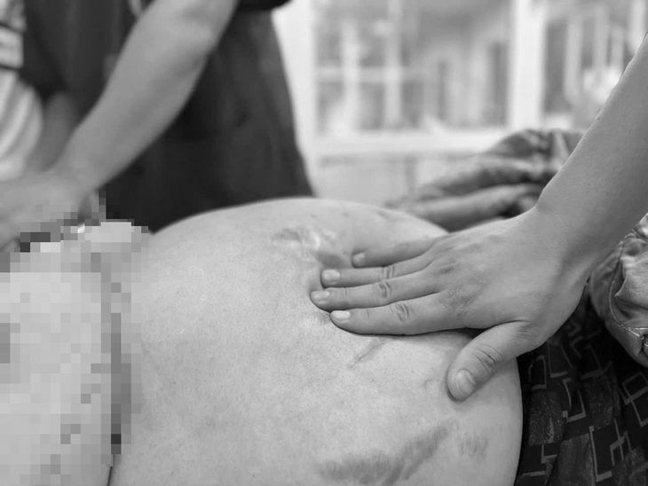 Mắc viêm gan B suốt 20 năm không điều trị, vào viện 1 ngày đành xin về vì quá nguy kịch- Ảnh 3. Mắc viêm gan B suốt 20 năm không điều trị, vào viện 1 ngày đành xin về vì quá nguy kịch- Ảnh 3.