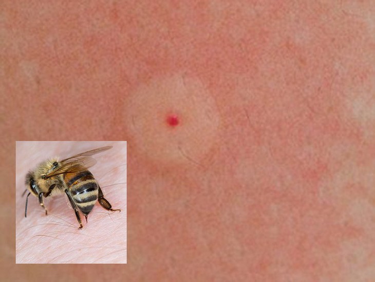 Bé 3 tuổi bị sốc phản vệ độ 3, suy hô hấp do ong đốt- Ảnh 1.