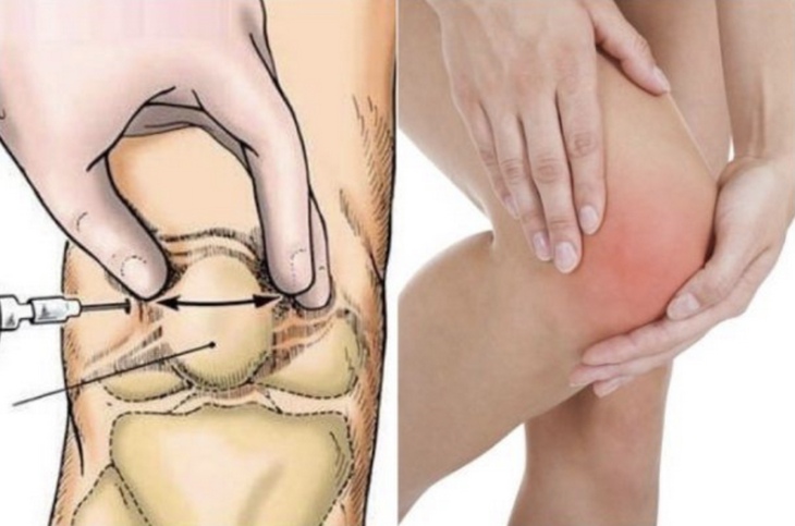 Viêm tủy xương: Nguyên nhân, triệu chứng, cách điều trị và phòng ngừa- Ảnh 1.