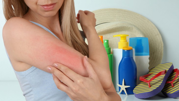 Cách xử trí khi bị dị ứng kem chống nắng- Ảnh 1.