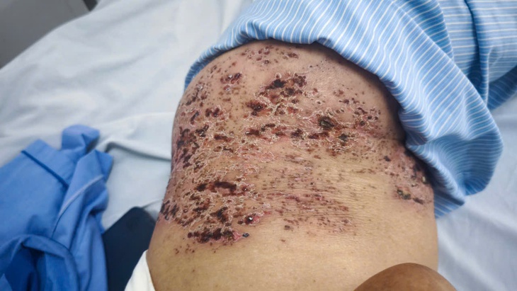 Nghĩ là 'giời leo' nên đắp đậu xanh, cụ ông bị tổn thương da nghiêm trọng do zona thần kinh- Ảnh 2.