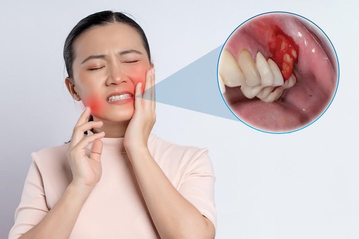 Nhiễm trùng Implant nguyên nhân do đâu? Dấu hiệu và cách khắc phục- Ảnh 1.