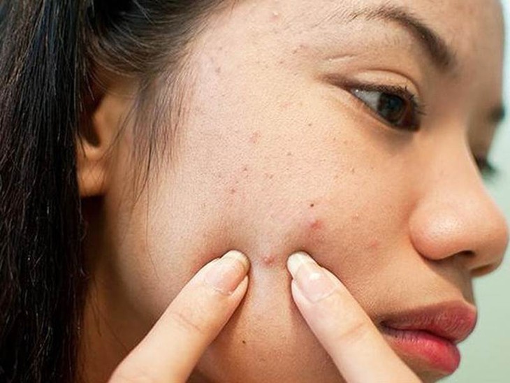 Sau nặn mụn không nên ăn gì?- Ảnh 1. Sau nặn mụn không nên ăn gì?- Ảnh 1.