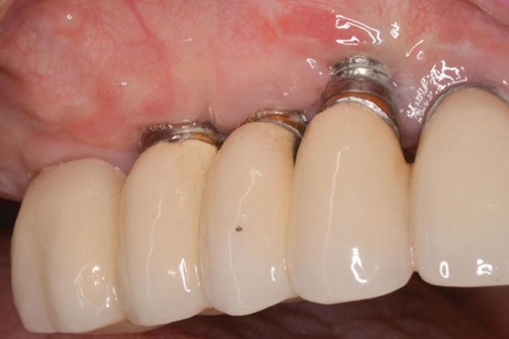 Implant bị đào thải do đâu? Cách khắc phục?- Ảnh 1.