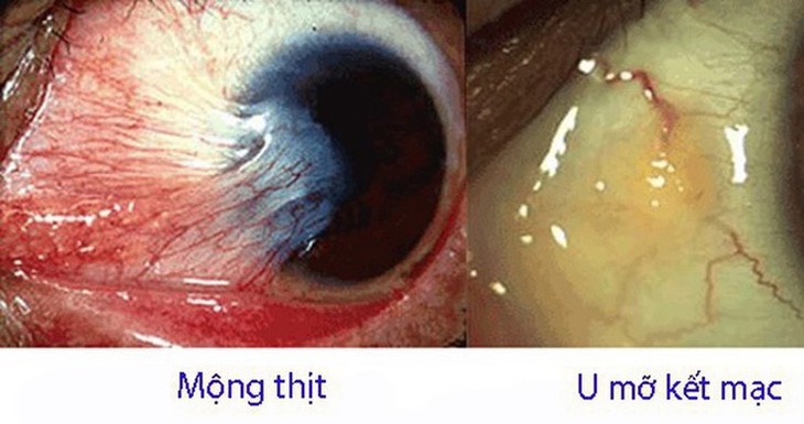 Mộng thịt: Đừng để những tổn thương nhỏ tước đi cơ hội lớn!- Ảnh 4.