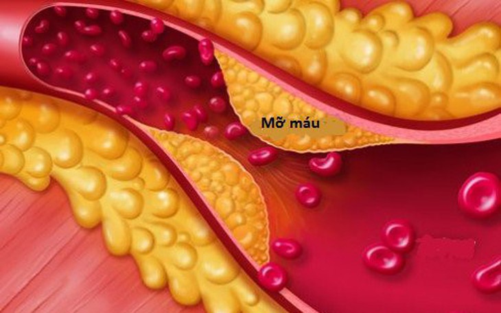 7 triệu chứng cảnh báo bạn mắc rối loạn mỡ máu