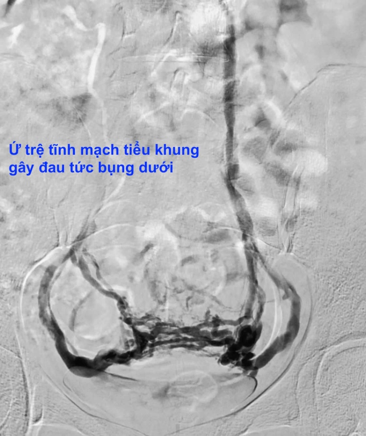 Đau bụng kéo dài hơn 10 năm, người phụ nữ phát hiện căn bệnh ít ai nghĩ tới- Ảnh 1.