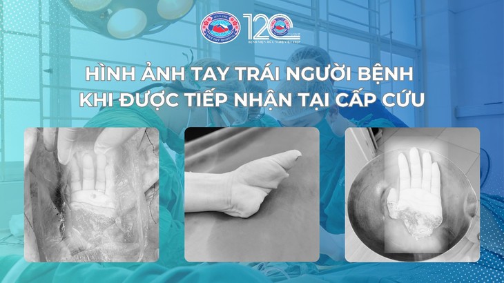 Bệnh viện Hữu nghị Việt Tiệp phẫu thuật tái nối thành công ca đứt rời nửa bàn tay trái, mở ra kỳ tích mới- Ảnh 1.
