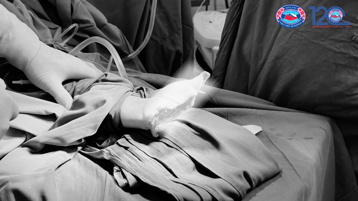 Bệnh viện Hữu nghị Việt Tiệp phẫu thuật tái nối thành công ca đứt rời nửa bàn tay trái, mở ra kỳ tích mới- Ảnh 3.