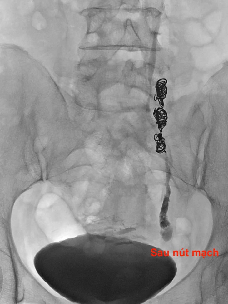 Đau bụng kéo dài hơn 10 năm, người phụ nữ phát hiện căn bệnh ít ai nghĩ tới- Ảnh 4.