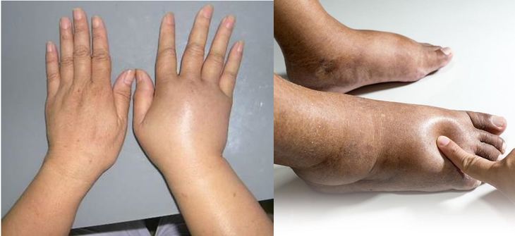 Phù là dấu hiệu của bệnh gì?- Ảnh 1.