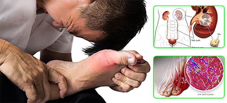 Bệnh gout ảnh hưởng thế nào đến tim, thận?- Ảnh 1.