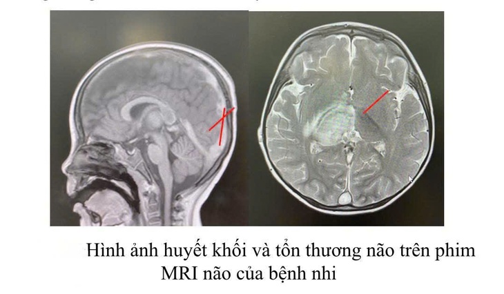 Cứu sống bé trai 2,5 tuổi bị huyết khối nội sọ do rối loạn chuyển hóa hiếm gặp- Ảnh 1. Cứu sống bé trai 2,5 tuổi bị huyết khối nội sọ do rối loạn chuyển hóa hiếm gặp- Ảnh 1.