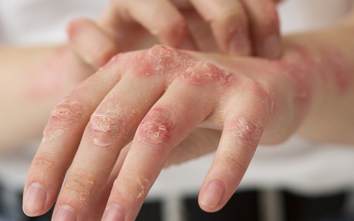5 bệnh về da nguy hiểm thường gặp sau bão, lũ lụt