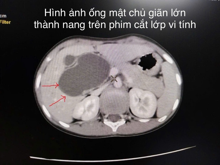 Bệnh viện Trẻ em Hải Phòng nội soi cắt nang ống mật chủ lớn cho bệnh nhi 10 tuổi- Ảnh 1.