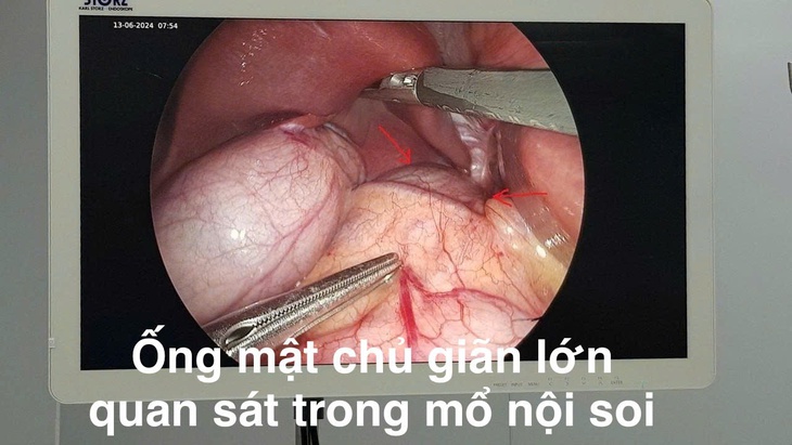Bệnh viện Trẻ em Hải Phòng nội soi cắt nang ống mật chủ lớn cho bệnh nhi 10 tuổi- Ảnh 2.