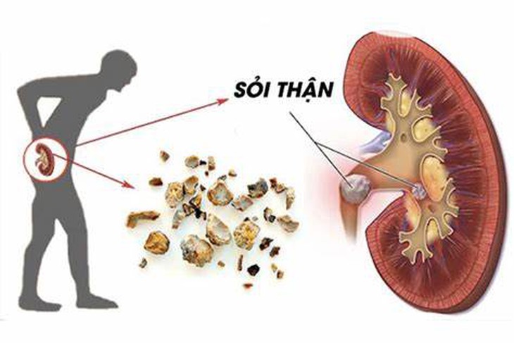 3 loại đồ uống lành mạnh hỗ trợ chức năng thải độc cho thận- Ảnh 1.