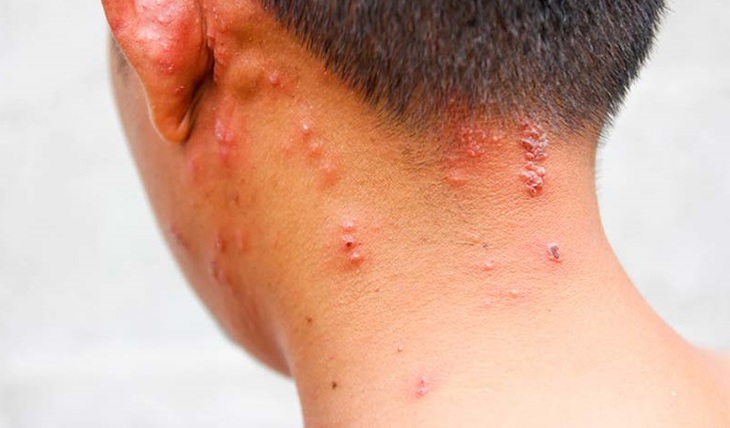 Cách chăm sóc bệnh nhân mắc zona thần kinh mau khỏi- Ảnh 1.