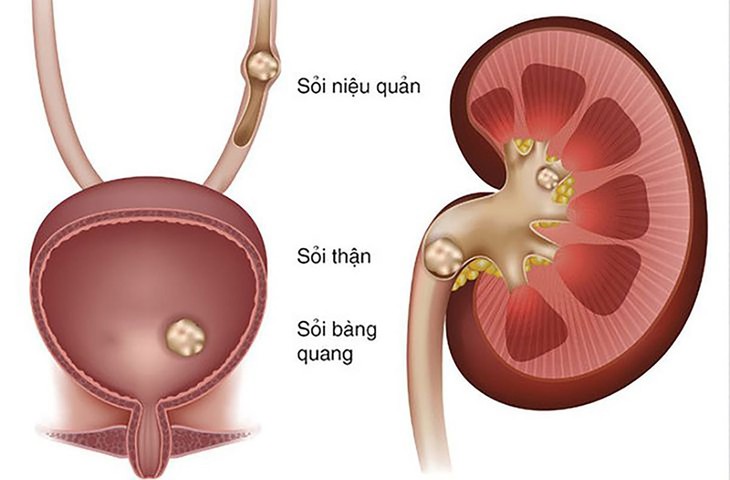 Cách ăn uống tốt nhất giúp ngăn ngừa hình thành sỏi thận- Ảnh 1.