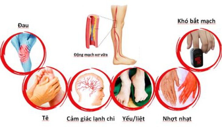 Xơ vữa động mạch ngoại biên: Nguyên nhân, triệu chứng, phòng bệnh và cách điều trị- Ảnh 4.