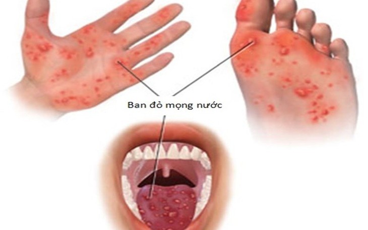 Nên chữa bệnh tay chân miệng ở nhà hay đến cơ sở y tế?