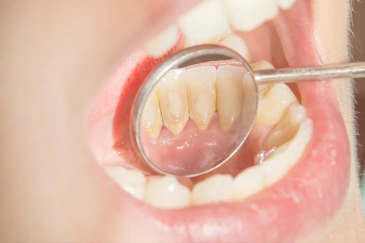 Cách nhận biết cao răng đang tích tụ- Ảnh 1.
