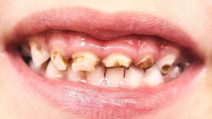 Chăm sóc răng miệng con trẻ: Những lưu ý quan trọng cha mẹ cần biết- Ảnh 1.