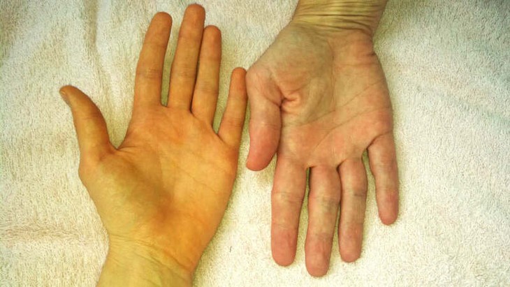 Cụ bà tắc ruột do sỏi túi mật: yếu tố nguy cơ nào gây sỏi túi mật?- Ảnh 1. Cụ bà tắc ruột do sỏi túi mật: yếu tố nguy cơ nào gây sỏi túi mật?- Ảnh 1.