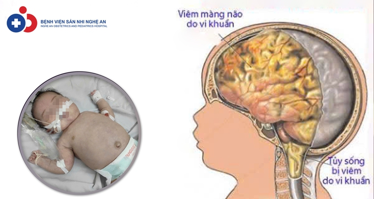 Cứu bé 20 ngày tuổi nguy kịch do viêm não mô cầu- Ảnh 1. Cứu bé 20 ngày tuổi nguy kịch do viêm não mô cầu- Ảnh 1.