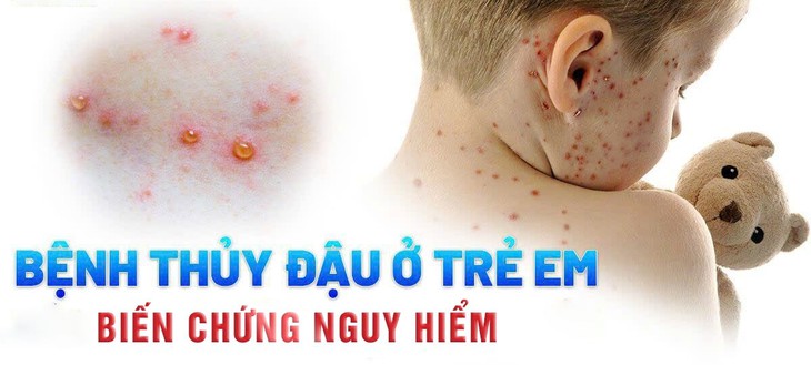 Cứu sống bé sơ sinh 15 ngày tuổi bị thủy đậu biến chứng ác tính- Ảnh 1.