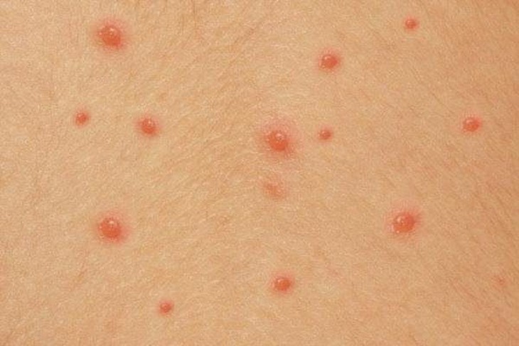 Cẩn trọng với bệnh thủy đậu gây biến chứng- Ảnh 1.