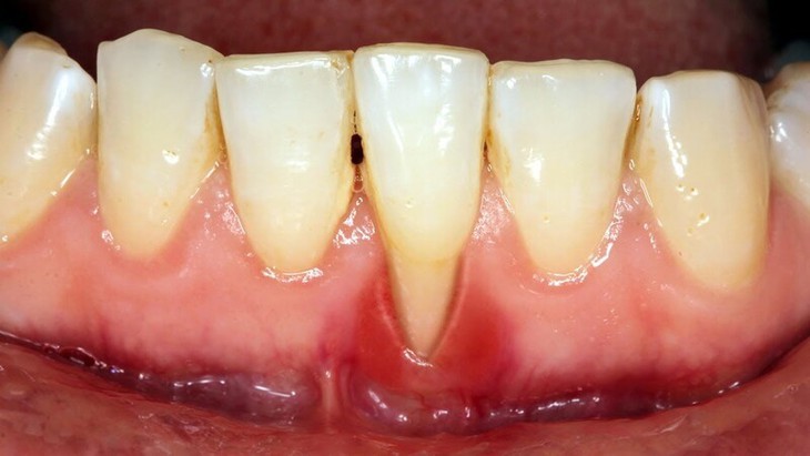 Ám ảnh tụt nướu: Dấu hiệu, nguyên nhân và 'lá chắn' bảo vệ nụ cười- Ảnh 1.