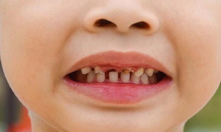 Bảo vệ những chiếc răng sữa xinh xắn: Tip bỏ túi cho phụ huynh- Ảnh 1.