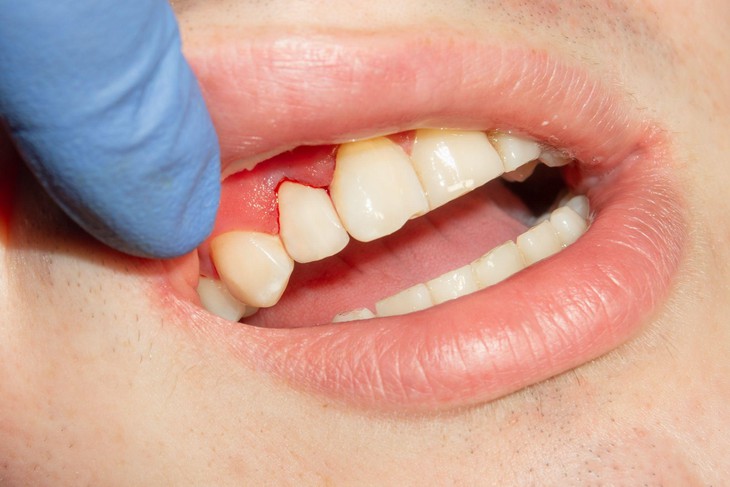 Chăm sóc răng miệng trong thai kỳ: mẹ bầu cần đặc biệt lưu ý- Ảnh 1.