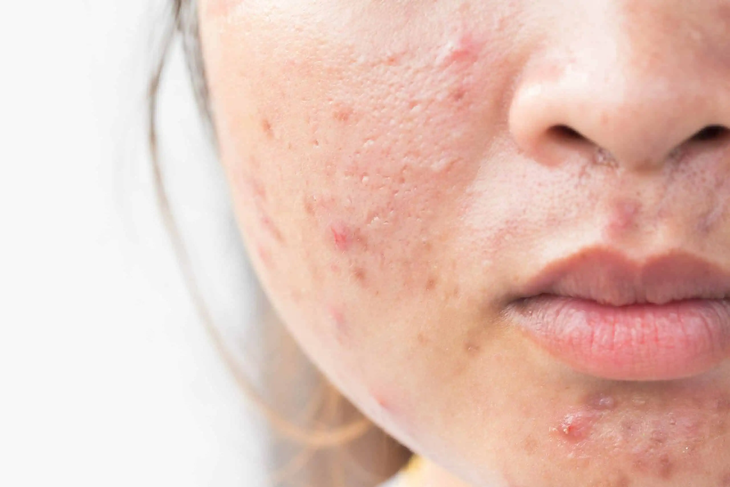 Thực phẩm dễ gây mụn trứng cá- Ảnh 2.
