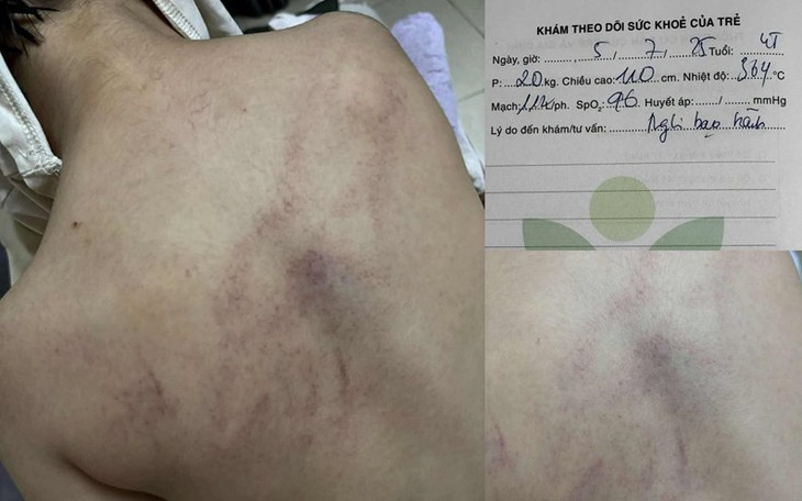 Cục Bà mẹ và Trẻ em lên tiếng về vụ trẻ bị bạo hành ở Hà Nội