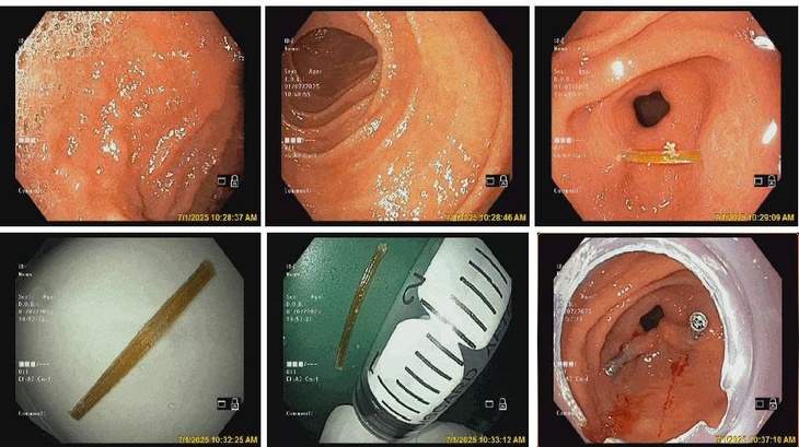 Bệnh nhi 8 tuổi bị tăm tre đâm xuyên thành dạ dày- Ảnh 1. Bệnh nhi 8 tuổi bị tăm tre đâm xuyên thành dạ dày- Ảnh 1.