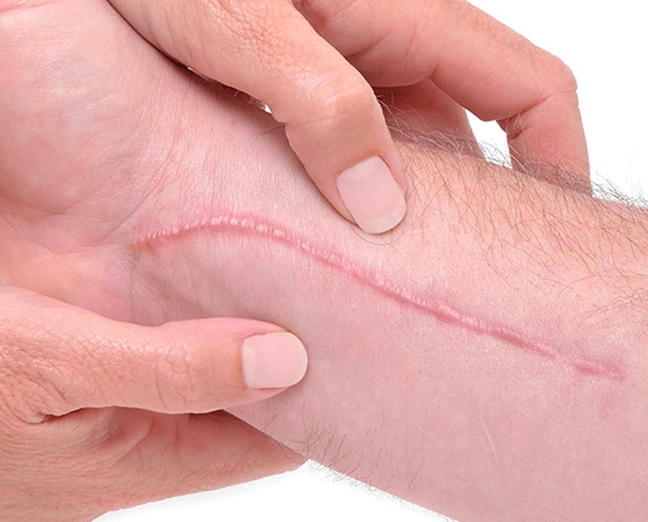 Kiêng gì để tránh bị sẹo lồi?- Ảnh 1.