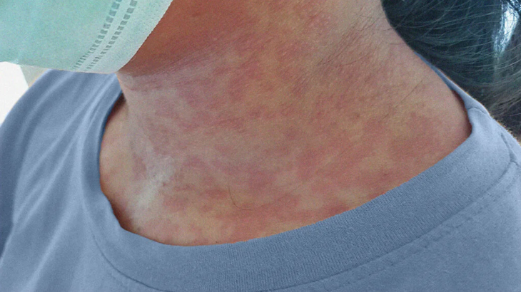 Nguy cơ mắc rubella: Cảnh báo với nhóm phụ nữ mang thai và trẻ nhỏ- Ảnh 1.