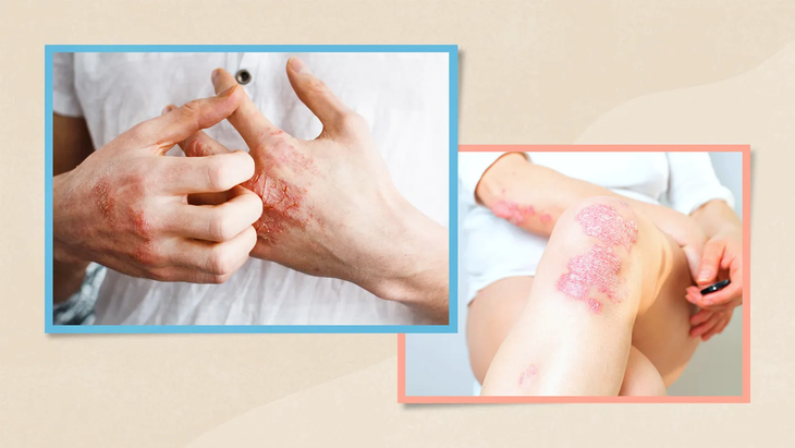 Thuốc điều trị bệnh vảy nến ở phụ nữ- Ảnh 1. Thuốc điều trị bệnh vảy nến ở phụ nữ- Ảnh 1.