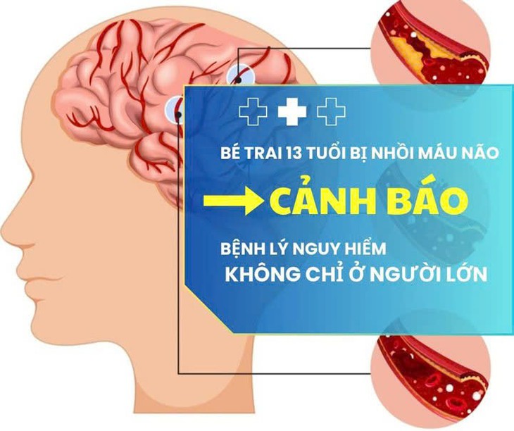 Bé trai 13 tuổi bị nhồi máu não: Cảnh báo bệnh lý nguy hiểm không chỉ ở người lớn- Ảnh 1.