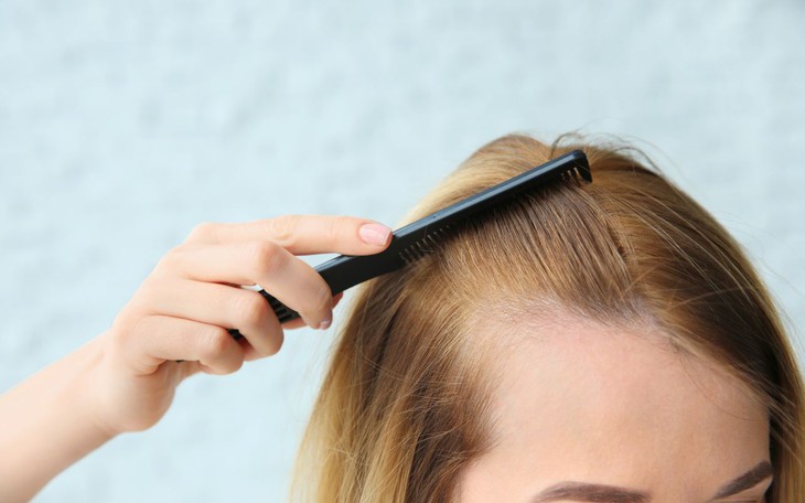 Dấu hiệu nhận biết sớm hói đầu và những lầm tưởng phổ biến- Ảnh 1.