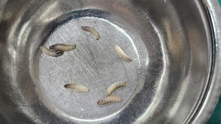 Rùng mình phát hiện ổ giòi 7 con làm tổ trong mũi bệnh nhân- Ảnh 2.