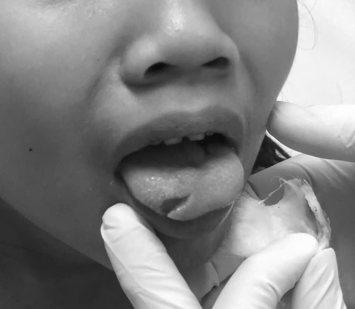  Bất cẩn lúc nô đùa, bé gái 7 tuổi bị kéo cắt vào lưỡi - Ảnh 1.