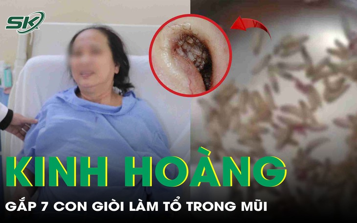 Ổ giòi làm tổ cùng dị vật sỏi trong hốc mũi khiến người phụ nữ nghẹt mũi, chảy máu liên tục