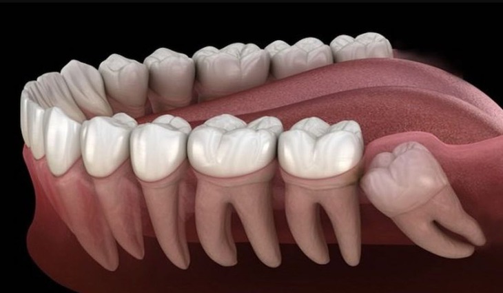 Sự thật ít ai biết về răng khôn không mọc- Ảnh 1.